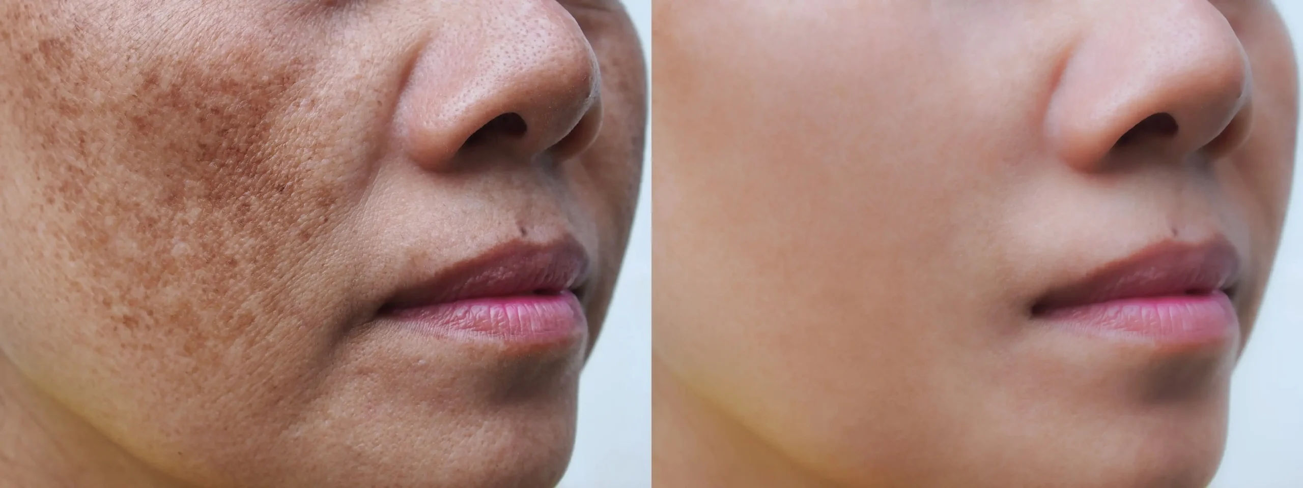 Melasma treatment in Abu Dhabi