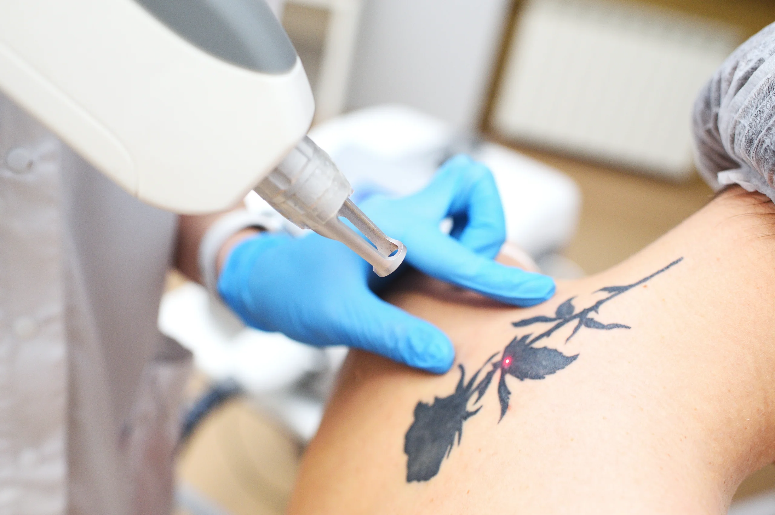 Laser tattoo removal in Abu Dhabi